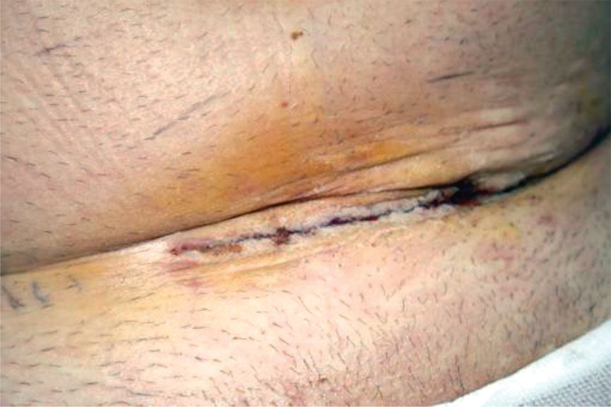 Figur 4. Pfannenstiel-snittet 5 dager etter laparoskopisk, hånd-assistert living donor nefrectomi, med bruk av Liquiband Laparoscopic.